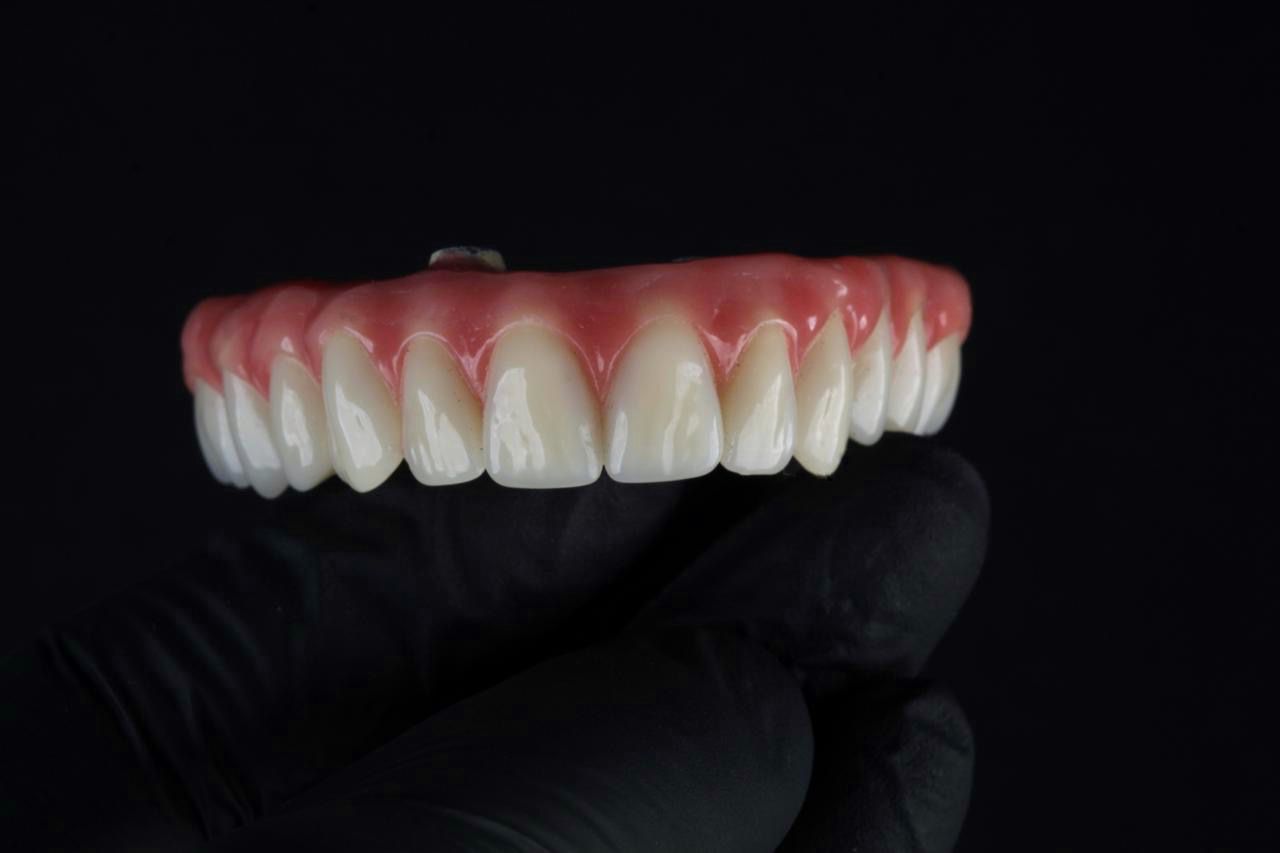 Arcada superior em zircônia — caso real prótese protocolo Sallut Odontologia Valinhos
