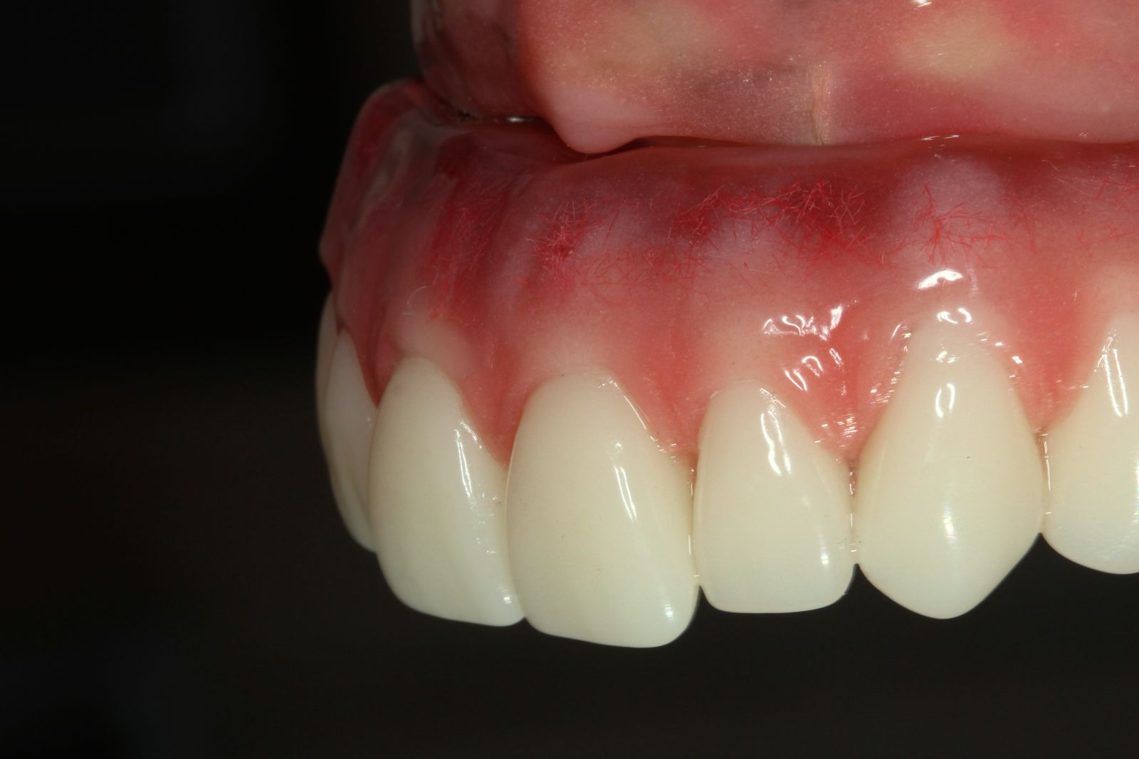 Mucosa periimplantar — caso real prótese protocolo Sallut Odontologia Valinhos